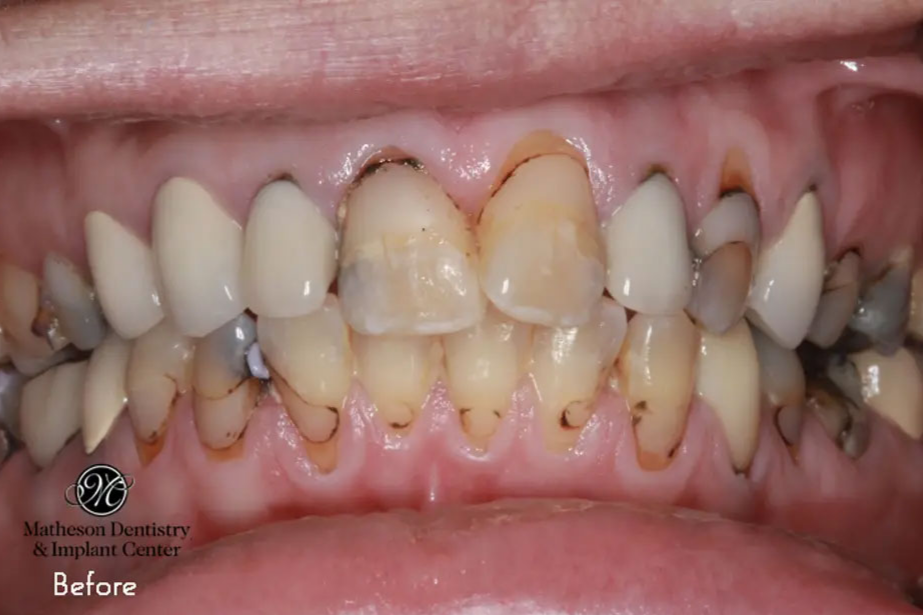 Heather before porcelain crown treatment