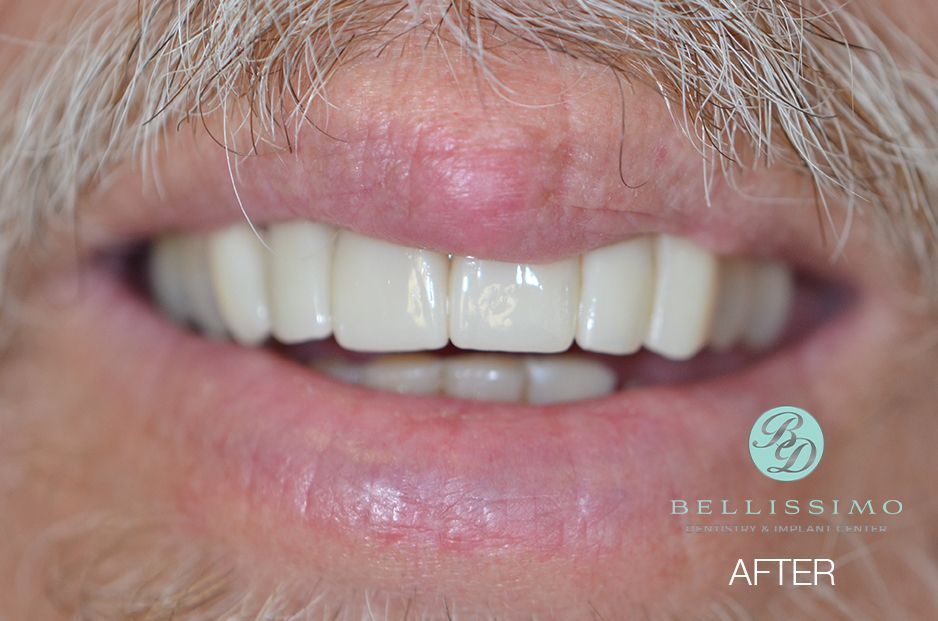 Larry after crown and bridge treatment