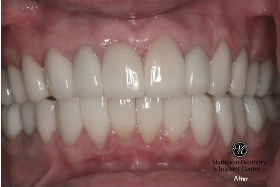 Heather after porcelain crown treatment