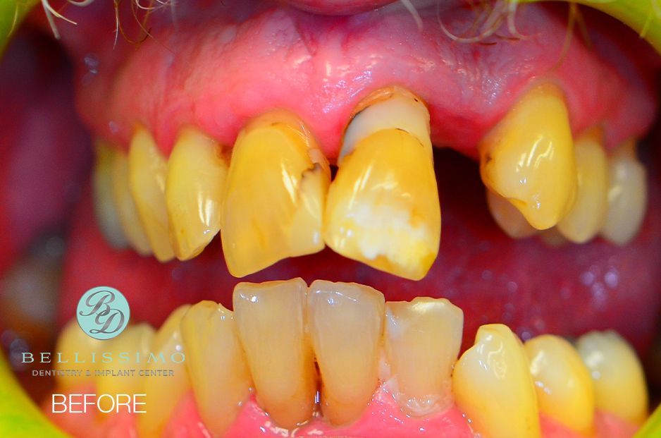 Larry before crown and bridge treatment